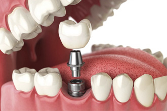 Внедрение имплантации в стоматологическую клинику с нуля
