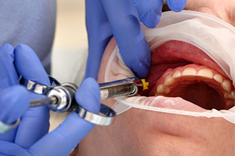 Эффективная методика анестезии нижней челюсти