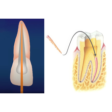 Гуттаперча и рекомендации по ее использованию в эндодонтии