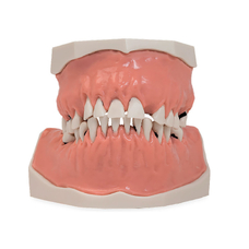 Модель верхней и нижней челюсти с патологией пародонта на разных стадиях заболевания