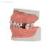 Модель верхней и нижней челюсти с патологией пародонта на разных стадиях заболевания | Dentalstore (Италия)