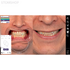 Exocad Smile Creator - модуль для планирования улыбки | Exocad (Германия)