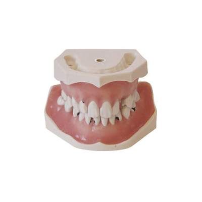 E06  – модель верхней и нижней челюсти с кариесом корня и патологией пародонта | GF Dental (Италия) 