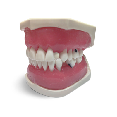 E56  – модель верхней и нижней челюсти с кариесом корня и патологией пародонта | GF Dental (Италия) 