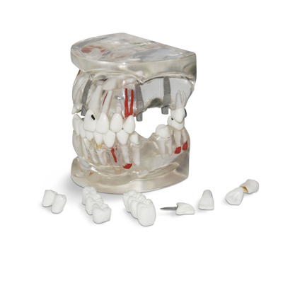 T04 – демонстрационная модель верхней и нижней челюсти c различными патологиями | GF Dental (Италия)