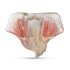 T21 – демонстрационная модель верхней челюсти с атрофией альвеолярного гребня