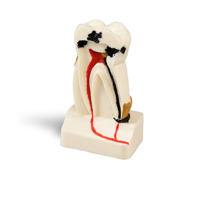 DM14 – увеличенная модель моляра для демонстрации развития кариеса,  высота 10 см | GF Dental (Италия)