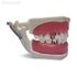 E56  – модель верхней и нижней челюсти с кариесом корня и патологией пародонта | GF Dental (Италия) 