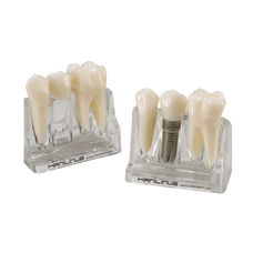 MODEL 2000 - модели, демонстрирующие имплантат и зубной мост