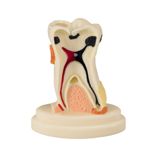 TOOTH MODEL S-TYPE - модель зуба с выделенными патологическими зонами