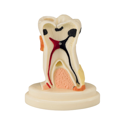 TOOTH MODEL S-TYPE - модель зуба с выделенными патологическими зонами | Hanil (Ю. Корея)