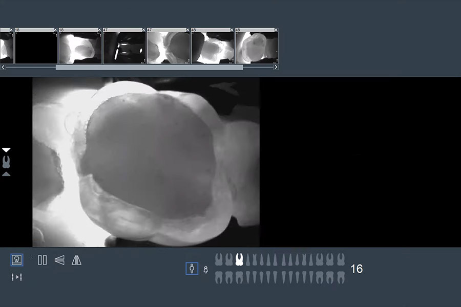 Снимок зуба в интерфейсе программы KaVo
